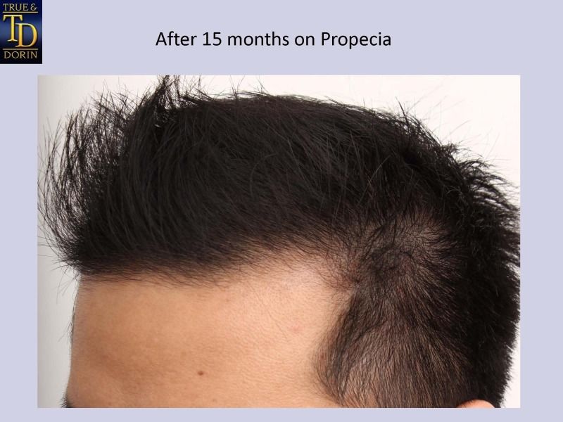 Propecia finasteride rezept ciprofloxacin calvizie Esempio di ottimo risponditore a Propecia